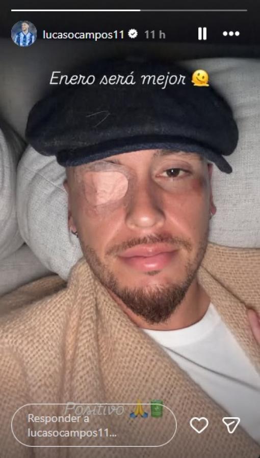 Imagen La parálisis facial que sufre Lucas Ocampos.