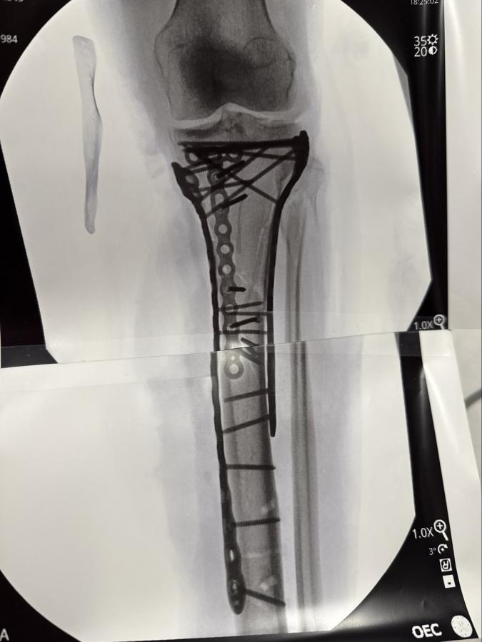 Imagen "Soy biónica", dijo Vonn al mostrar la radiografía de su fractura en la tibia.